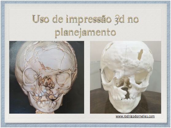 USP cria projeto que simula cirurgia craniana com impressão 3D e