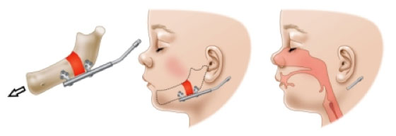 cirurgia-cranio