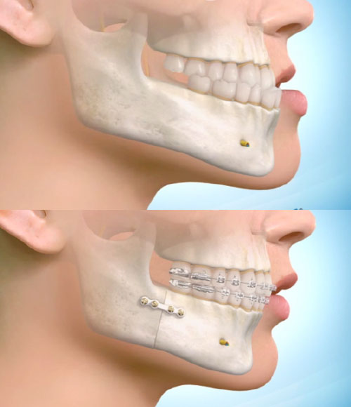 recuo-mandibula