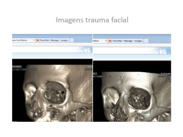 trauma-facial