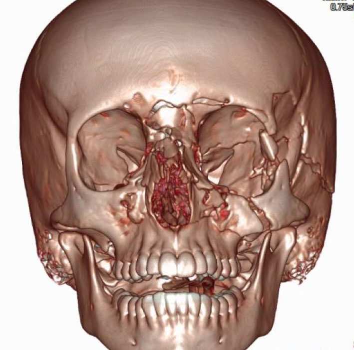 trauma-facial2