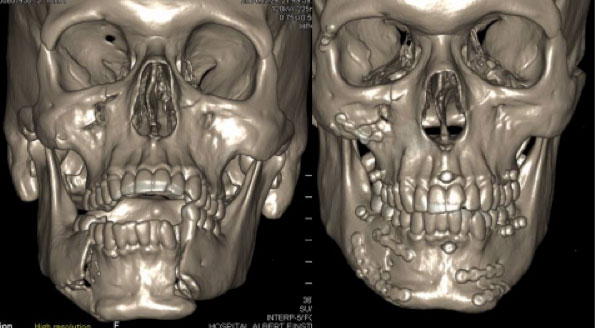 trauma-facial3